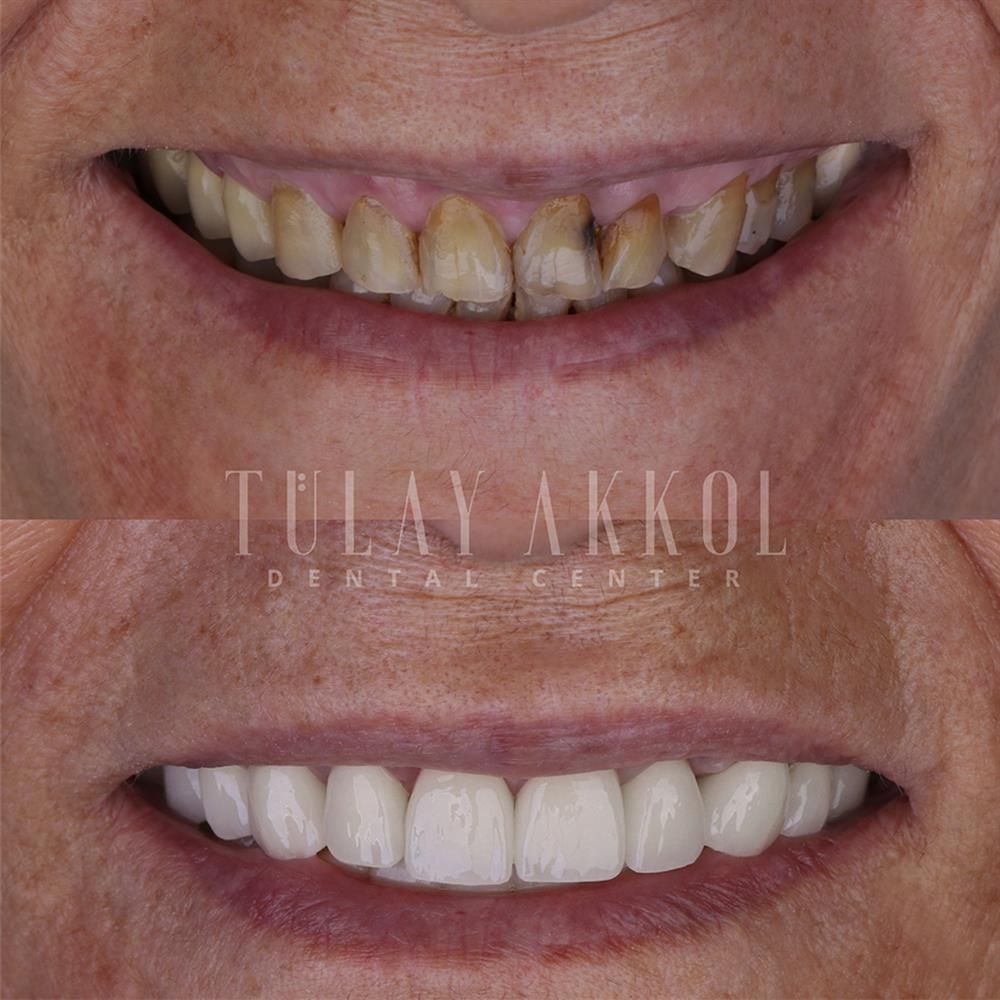 Laminate Veneers Transform Your Smile with Akkol Dental Affordable