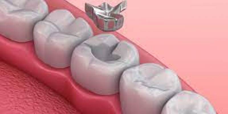 Amalgam Dental Filling